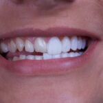 veneers